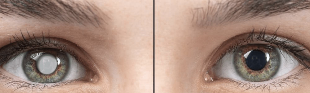 جراحة إعتام